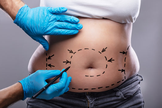 The Comprehensive Guide to Liposuction: Understanding the Procedure, Recovery, and Results