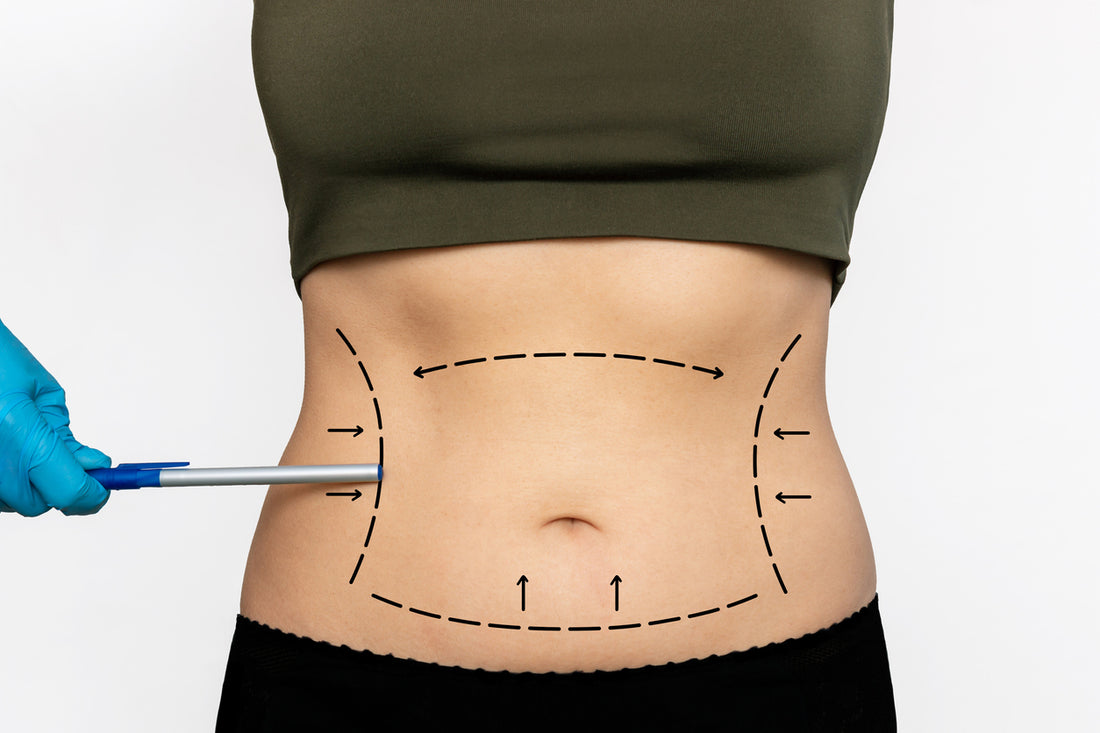 BBL And Liposuction: What Are They And Which Do I Go For?