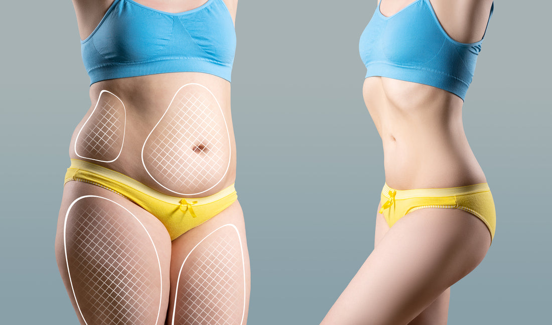 Liposuction Post-Surgery Recovery Timeline and Comfort Measures