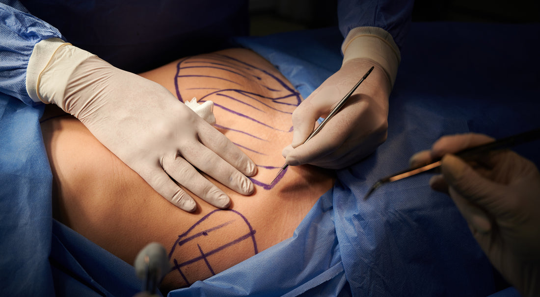 A Comprehensive Guide to Tummy Tuck Surgery